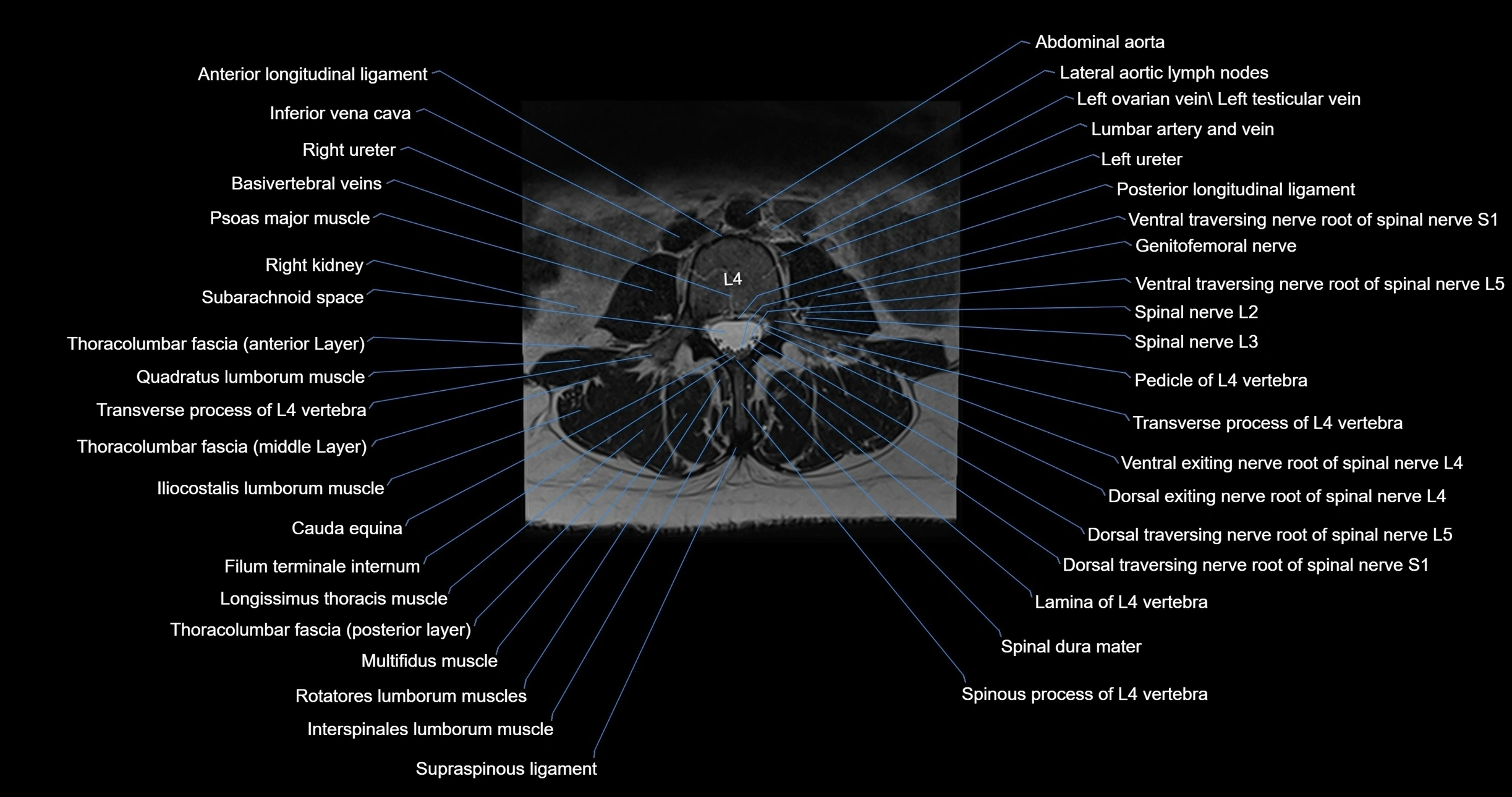 MRI lumbar spine axial cross sectional anatomy 3T radiology  image-img-00001-00030.webp